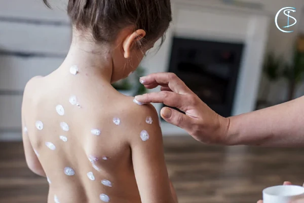 آبله مرغان در کودکان