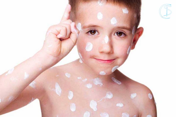 آبله مرغان در کورکی