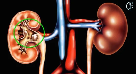 علائم سنگ کلیه و راه های درمان آن
