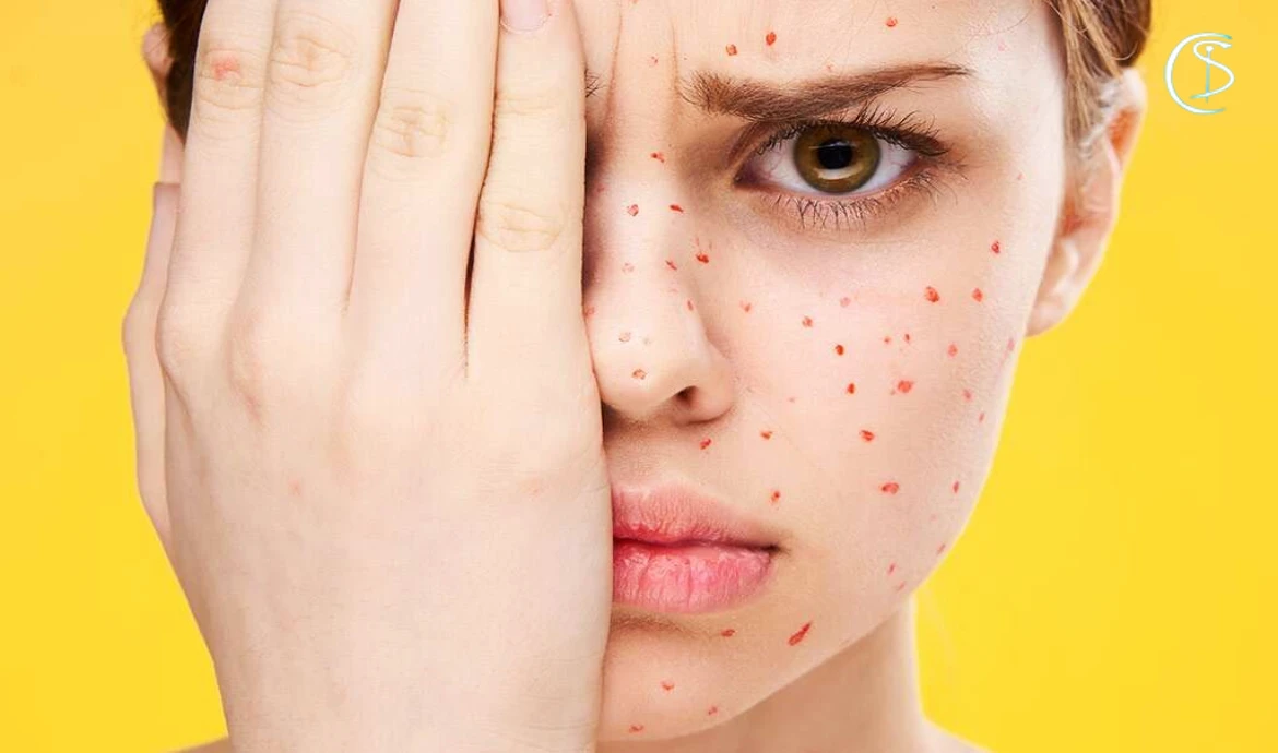 نشانه های آبله مرغان چیست؟