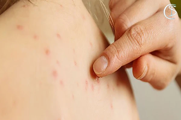 نشانه های آبله مرغان