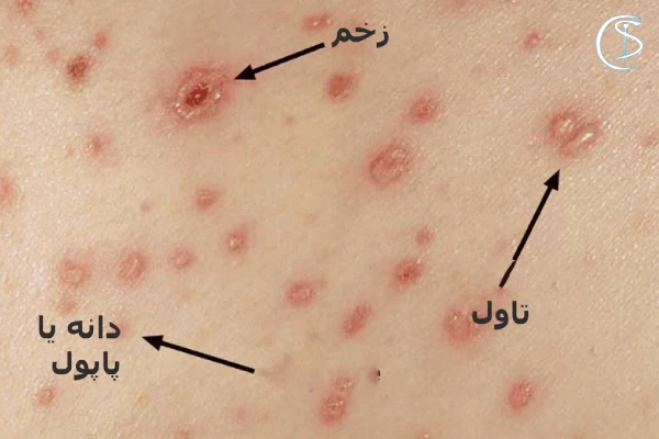 پماد نشانه های آبله مرغان