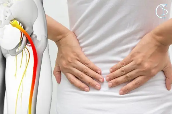 درمان خانگی سیاتیک