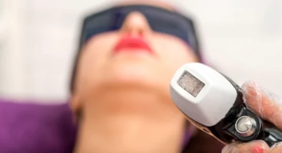 عوارض لیزر موهای زائد