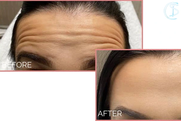 سن مناسب برای تزریق بوتاکس