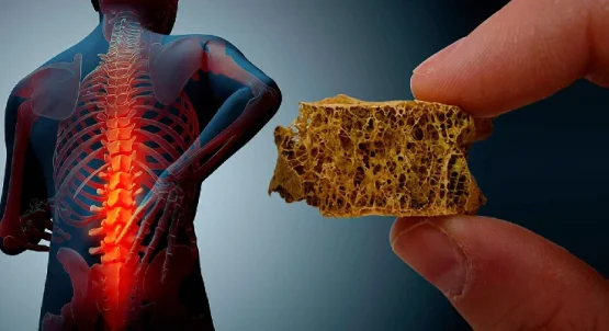 پوکی استخوان چیست و چگونه درمان می شود؟