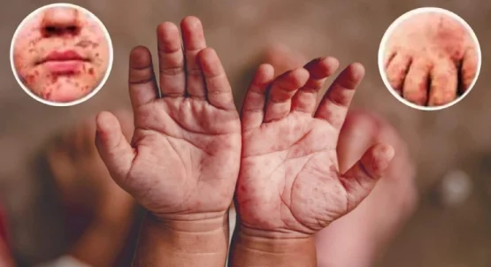بیماری دست، پا و دهان در کودکان