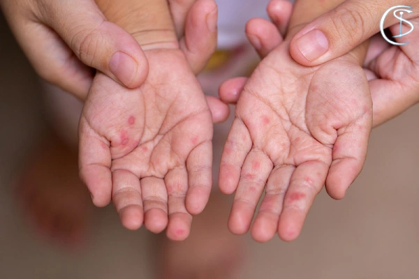 بیماری دست پا دهان چند روز طول میکشد؟