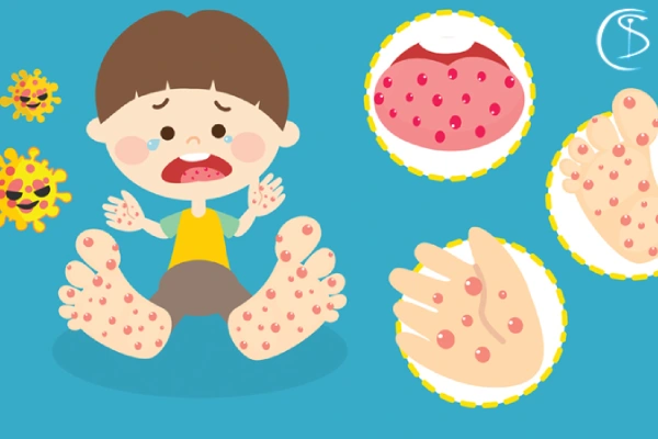 علل بیماری دست، پا و دهان در کودکان