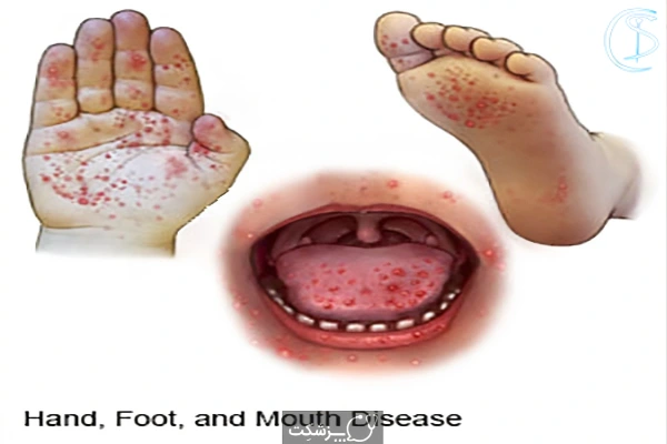نشانه های بیماری دست، پا و دهان در کودکان
