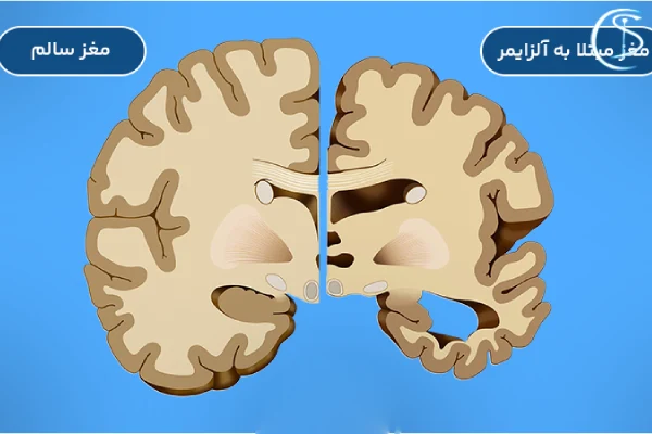تشخیص بیماری آلزایمر