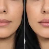 ترمیم ژل لب چند وقت یکبار لازم است؟