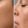 جوانسازی با پی آر اف صورت در کرج