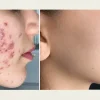 مزوتراپی صورت در کرج