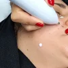 بهترین مرکز خالبرداری در كرج