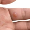 مرکز برداشت زگیل در کرج